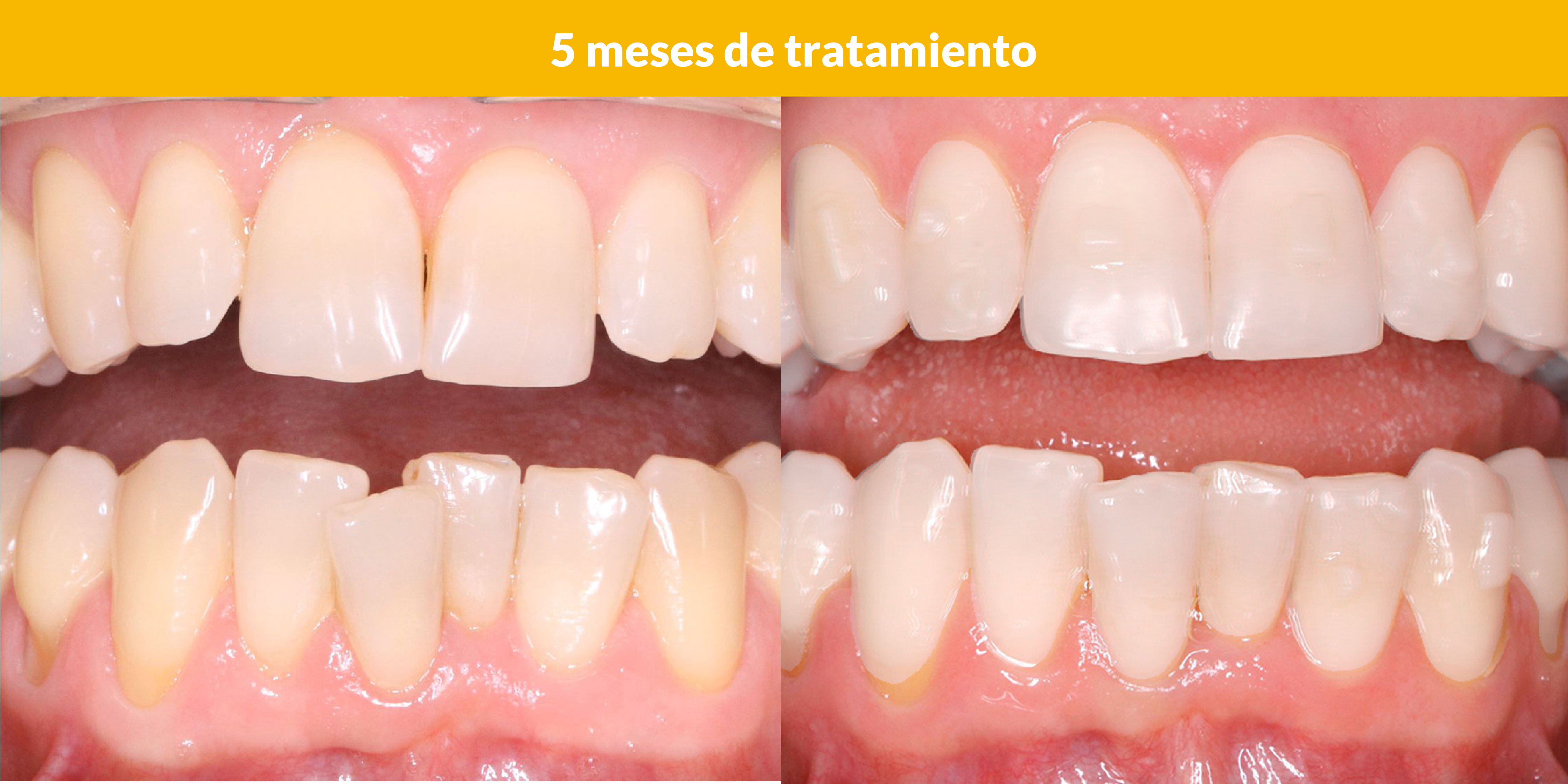 5 meses de tratamiento ortodoncia invisible