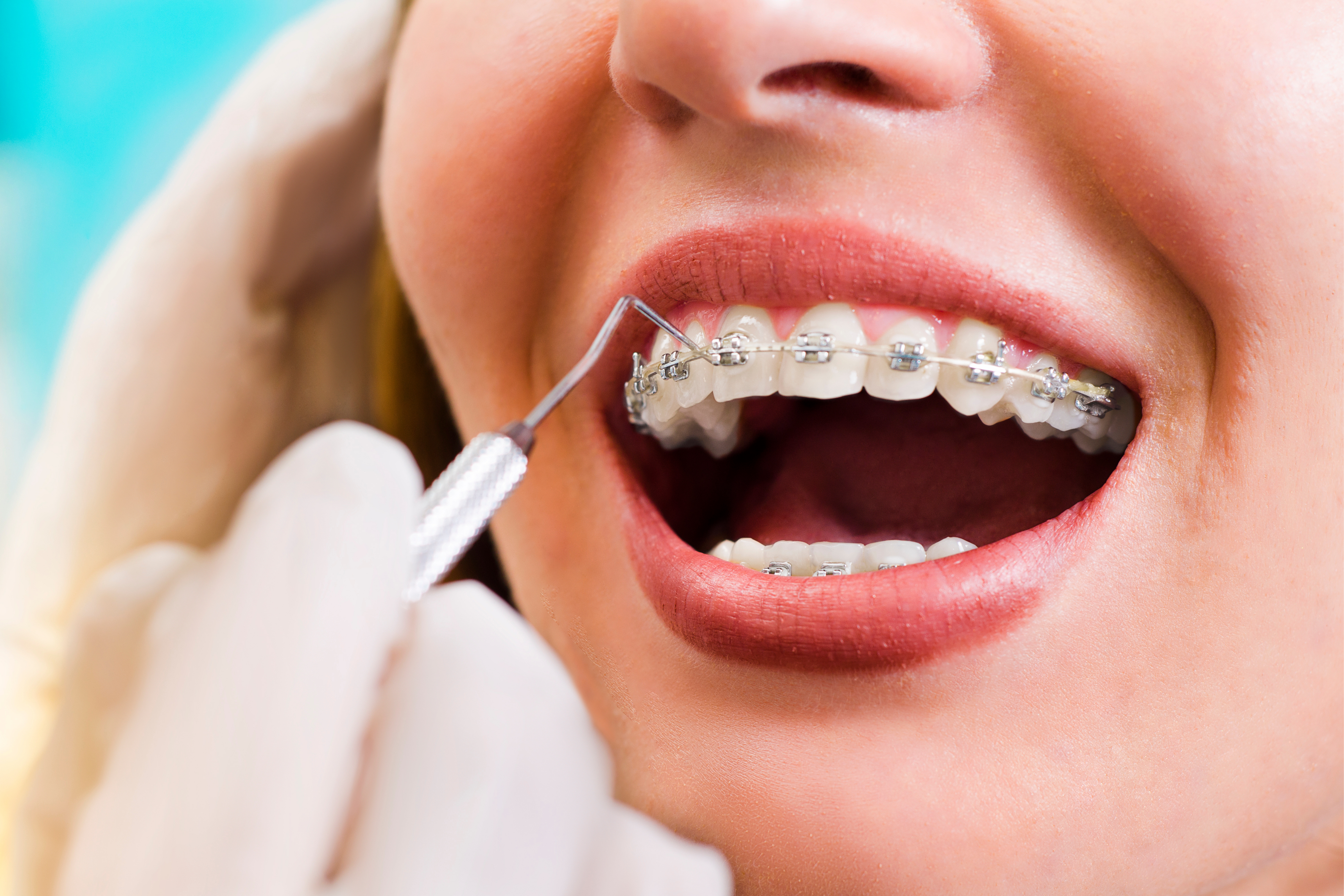 Tratamiento con brackets
