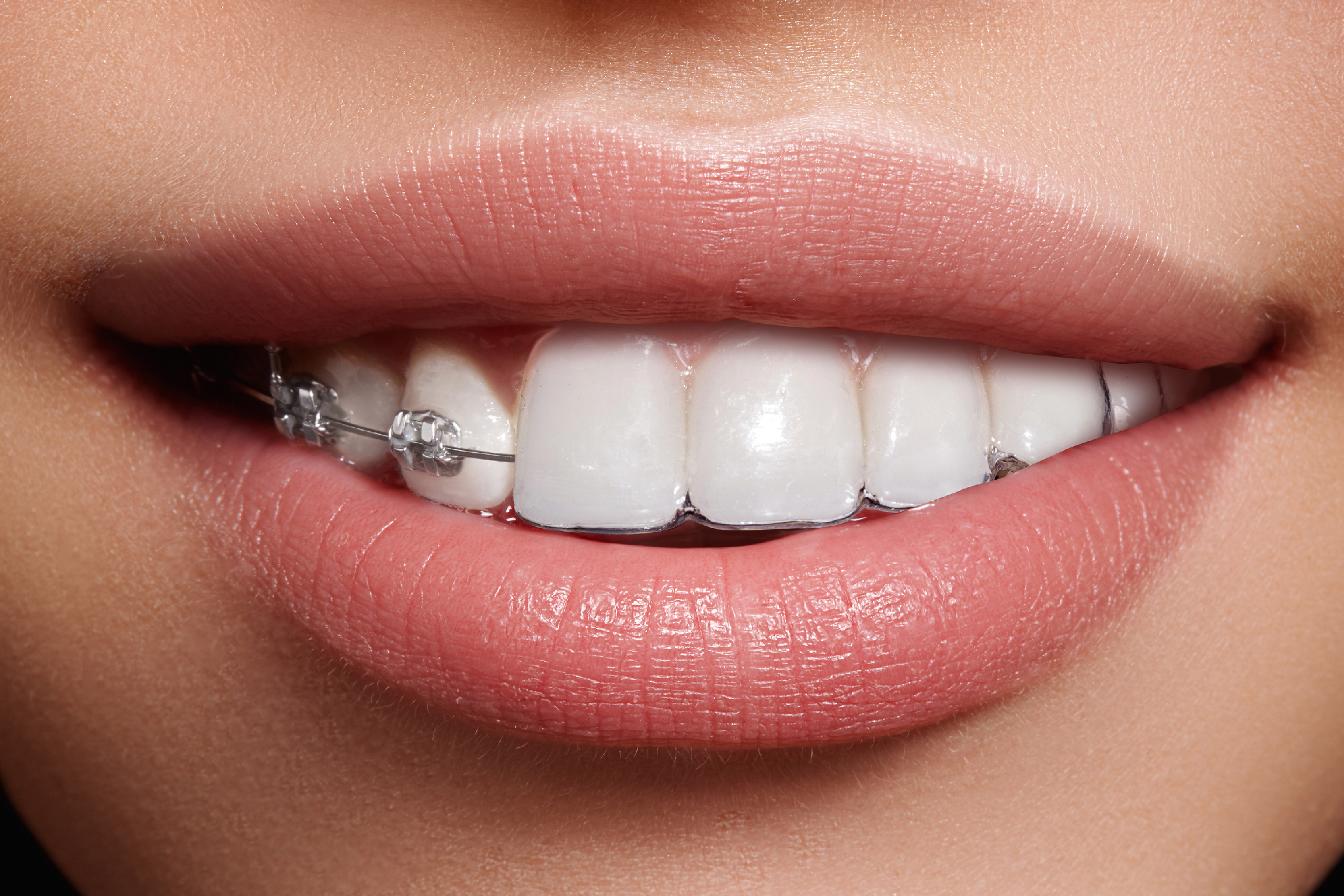 DIFERENCIAS ENTRE BRACKETS Y ORTODONCIA INVISIBLE