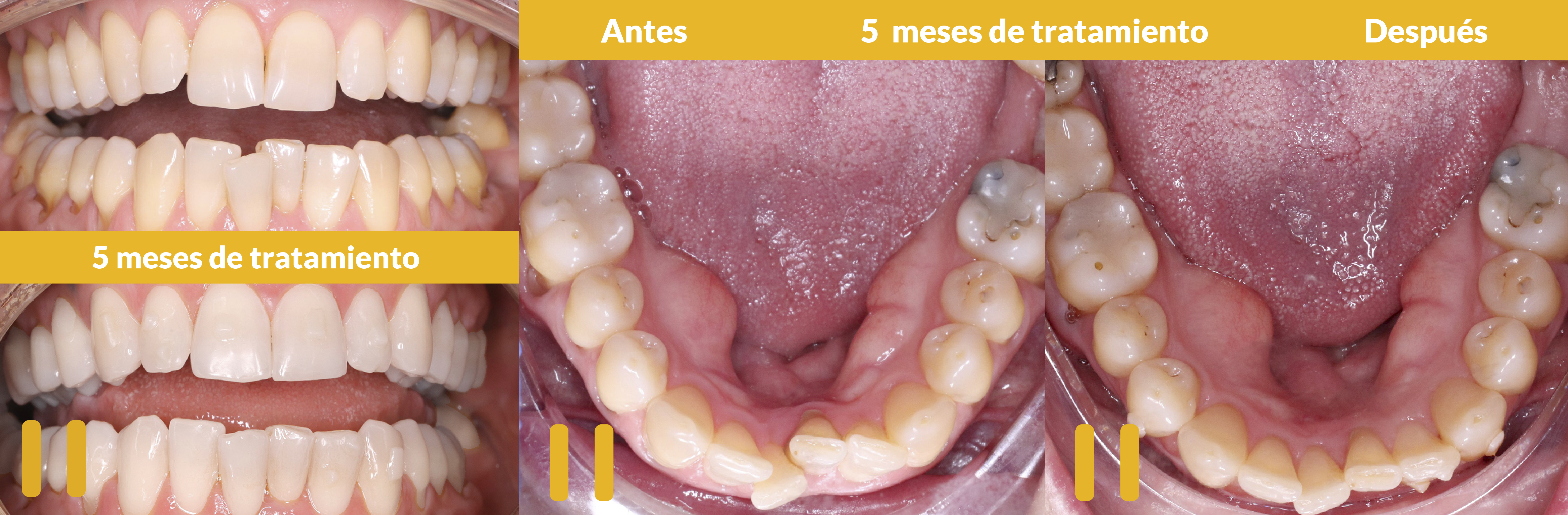 DIFERENCIAS ENTRE BRACKETS Y ORTODONCIA INVISIBLE