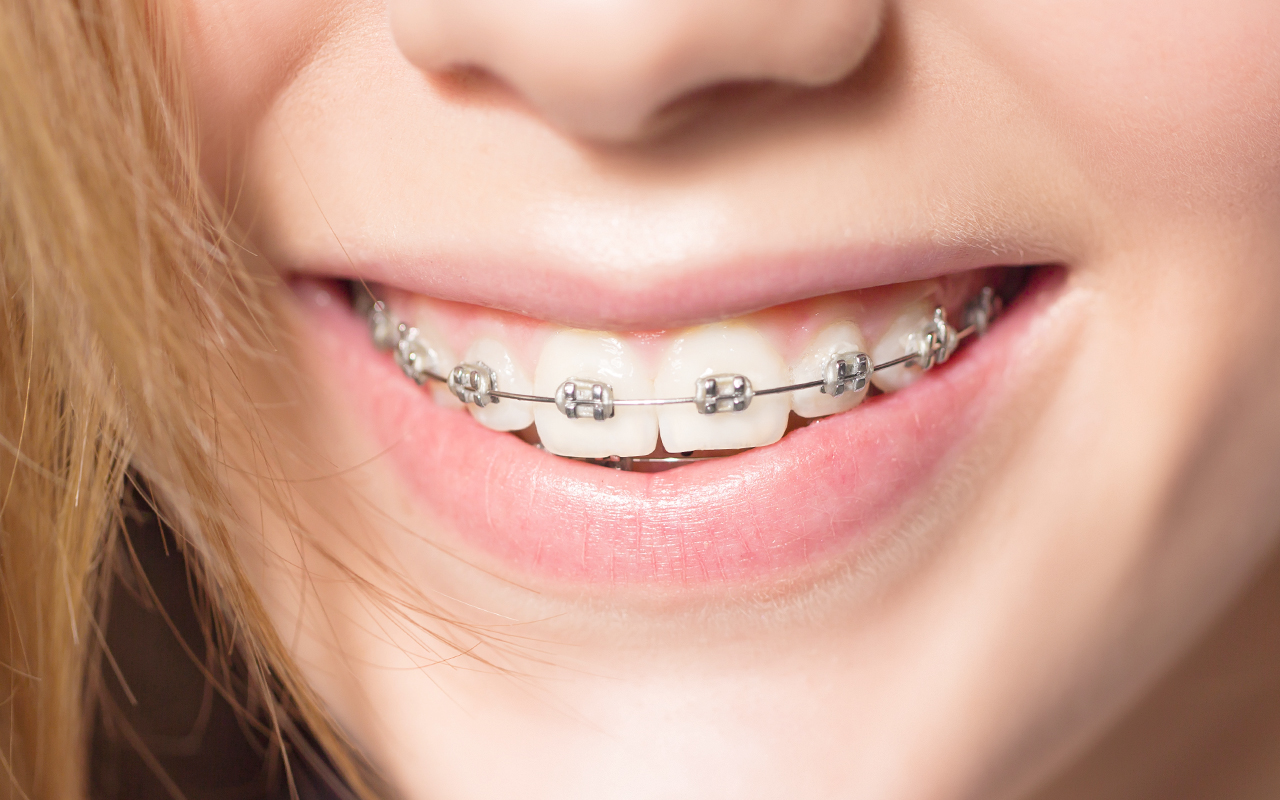 Sonrisa con brackets