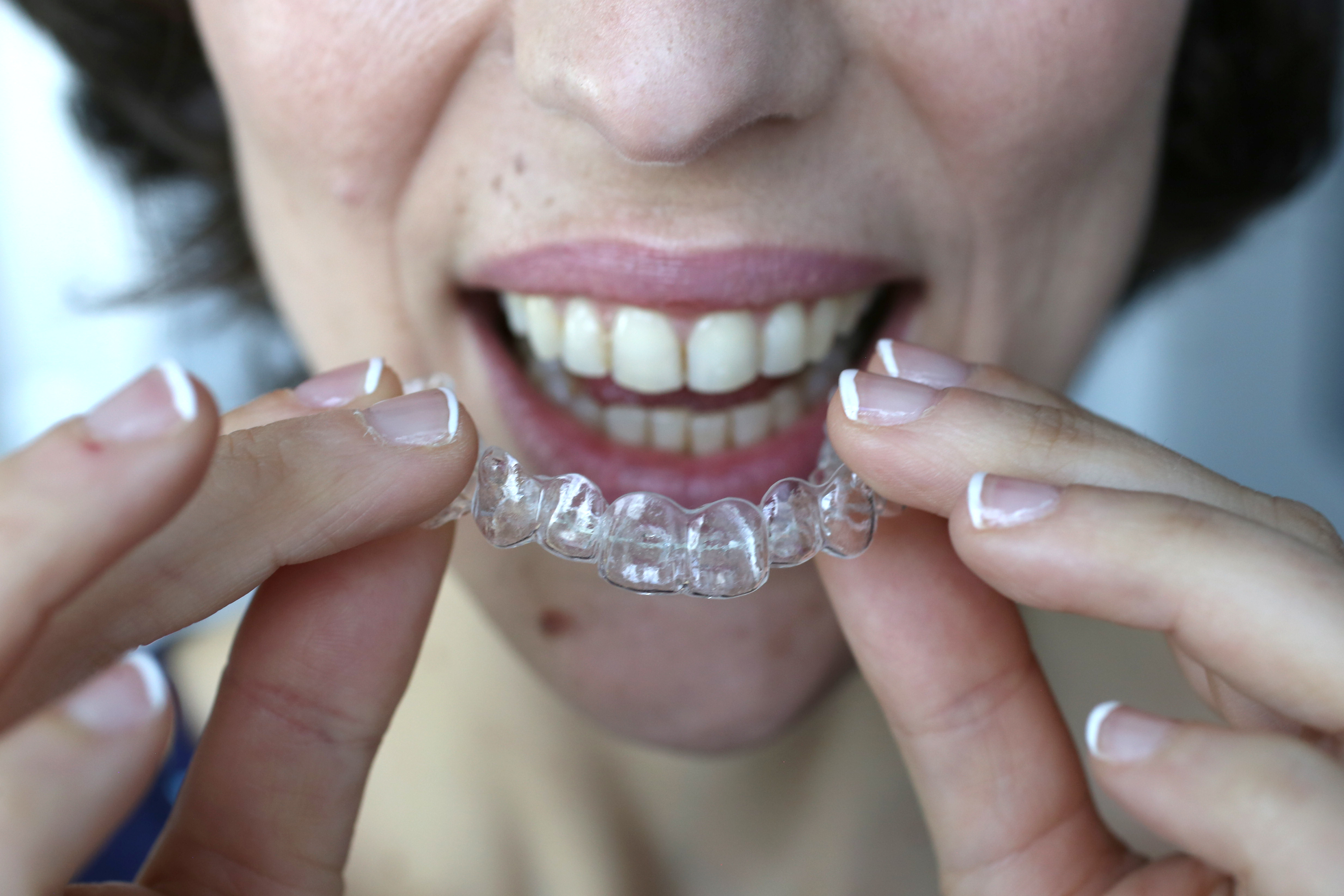 Sonrisa perfecta con alineador invisible en las manos