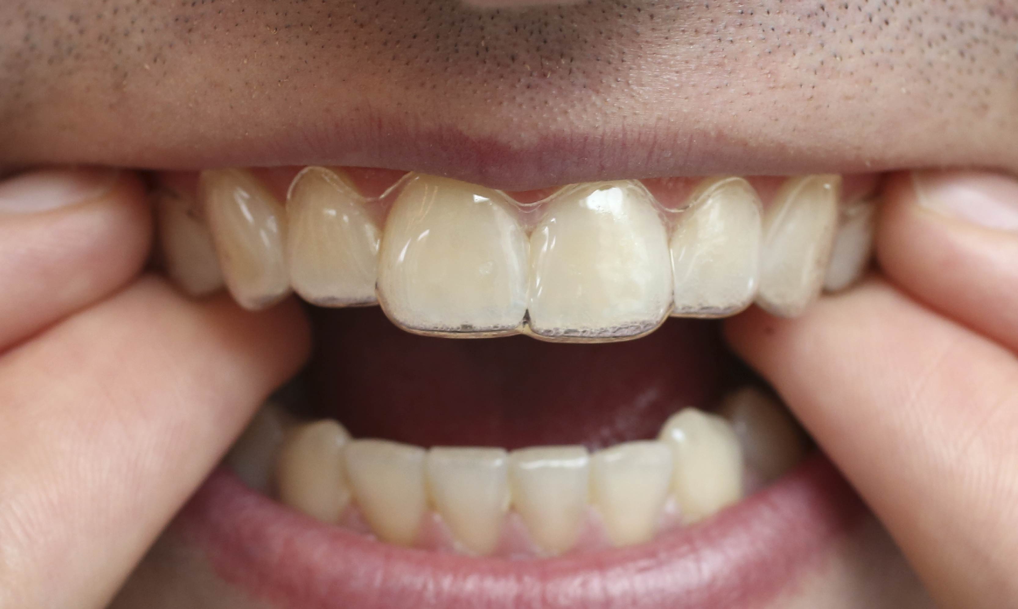 Cómo poner y quitar correctamente la ortodoncia invisible
