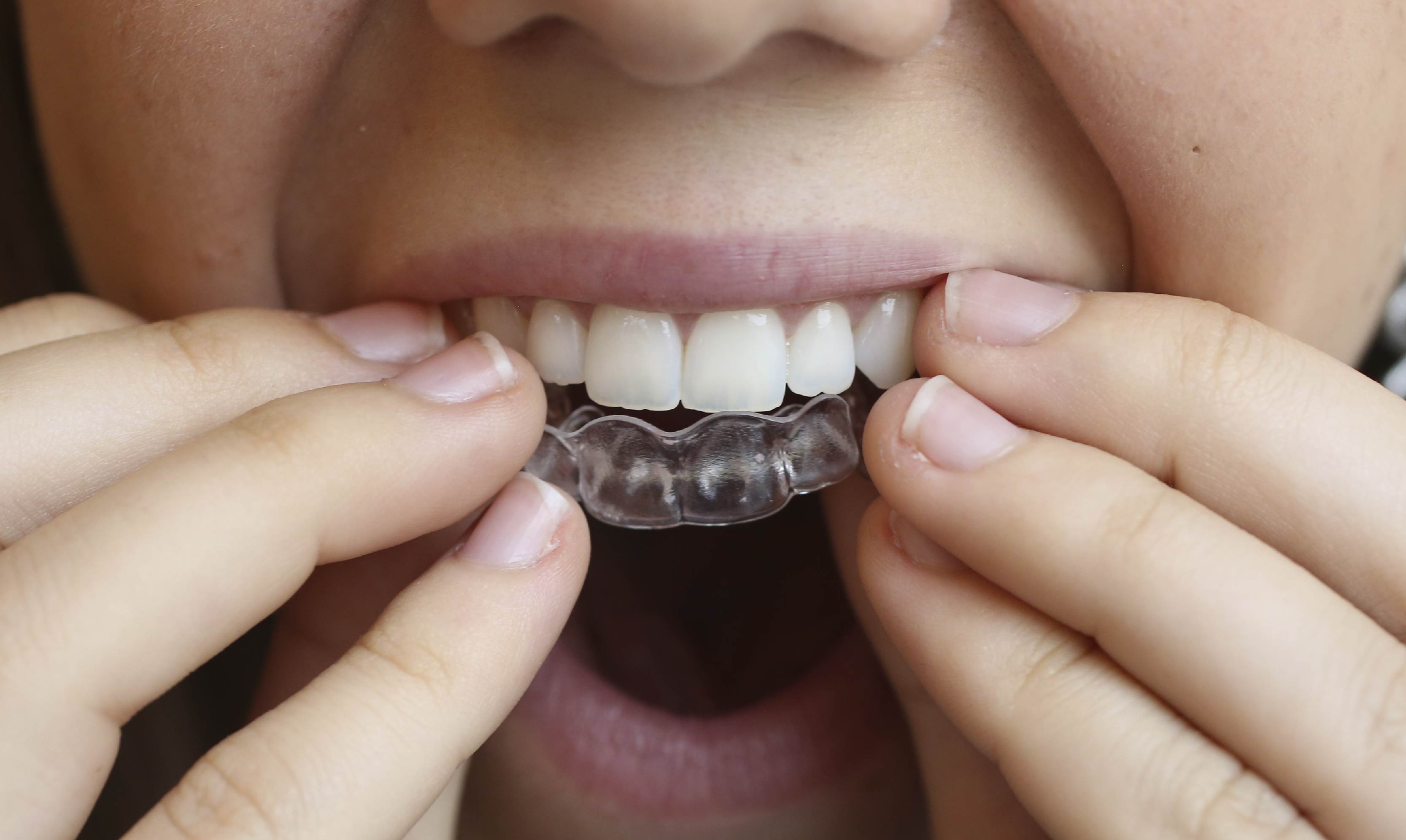 Cómo poner y quitar correctamente la ortodoncia invisible
