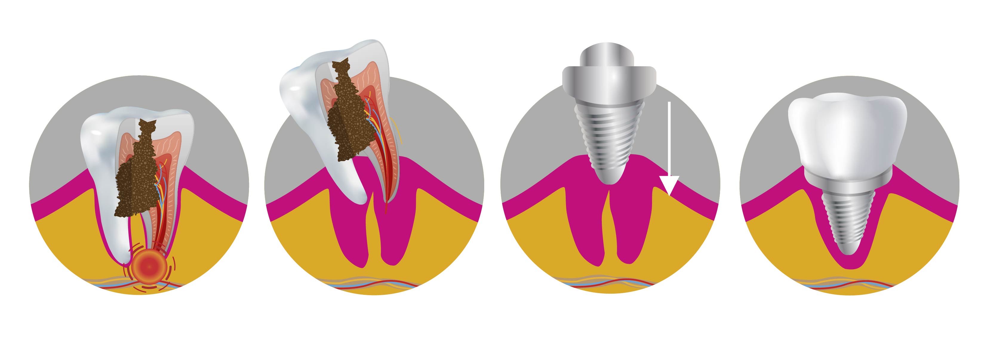 Implante dental