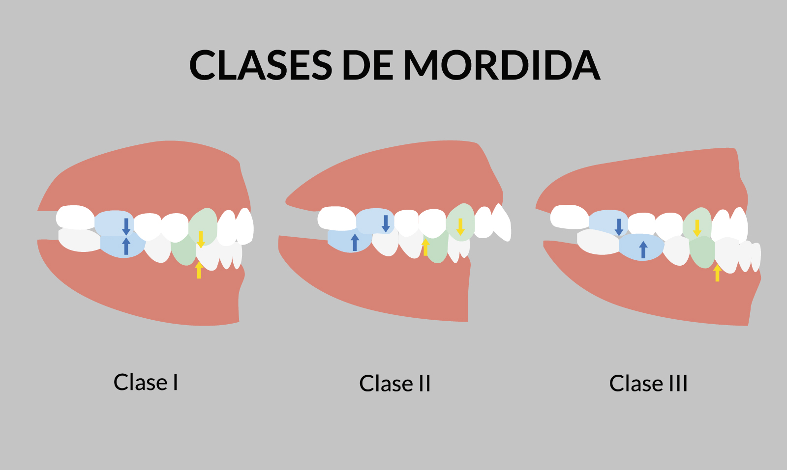 Clases de mordida
