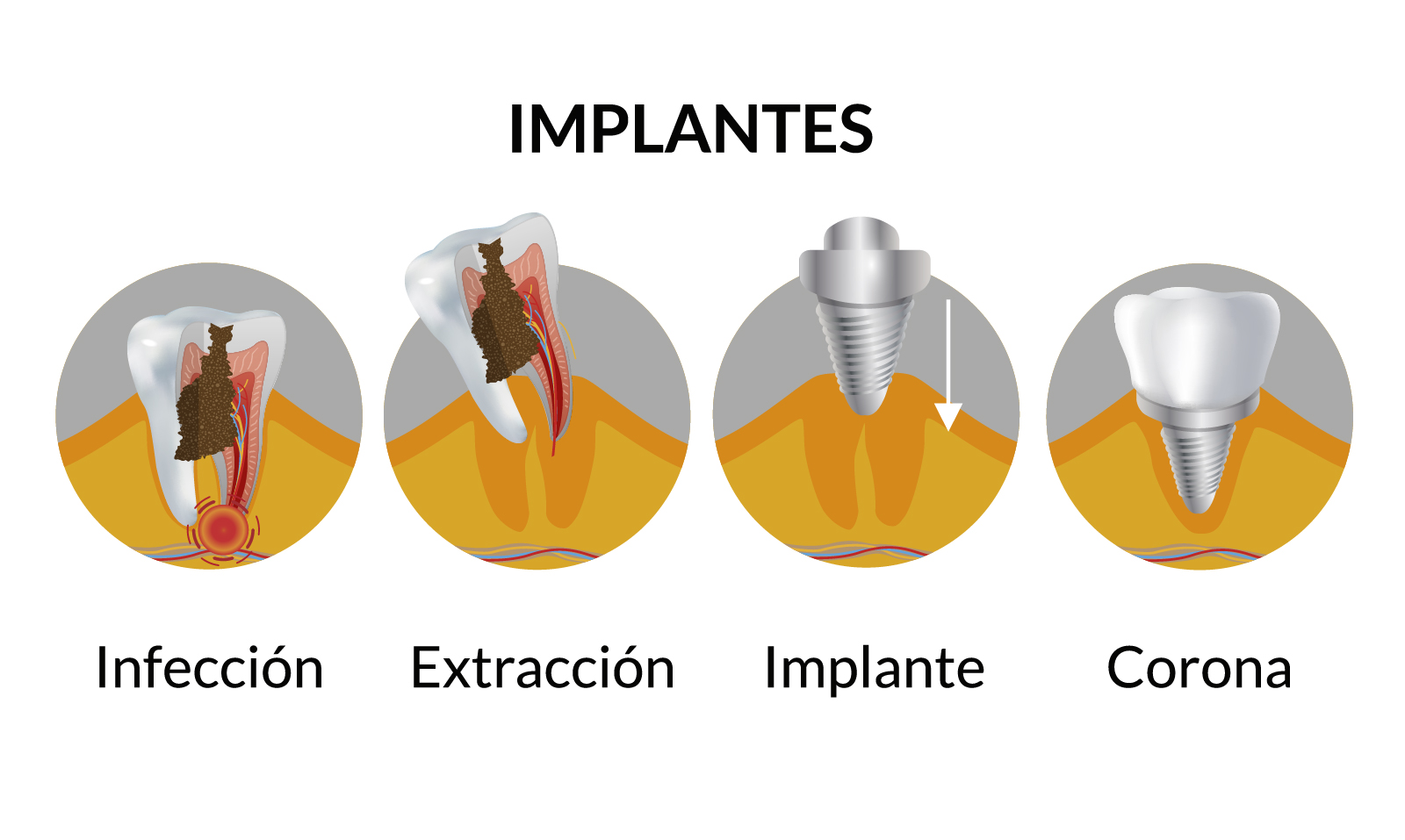 limpiar los implantes dentales