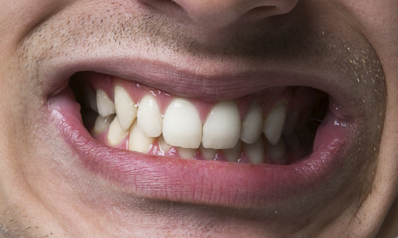 Maloclusión dental