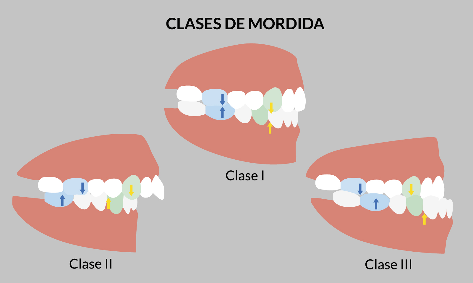maloclusión dental. Tipos de mordidas