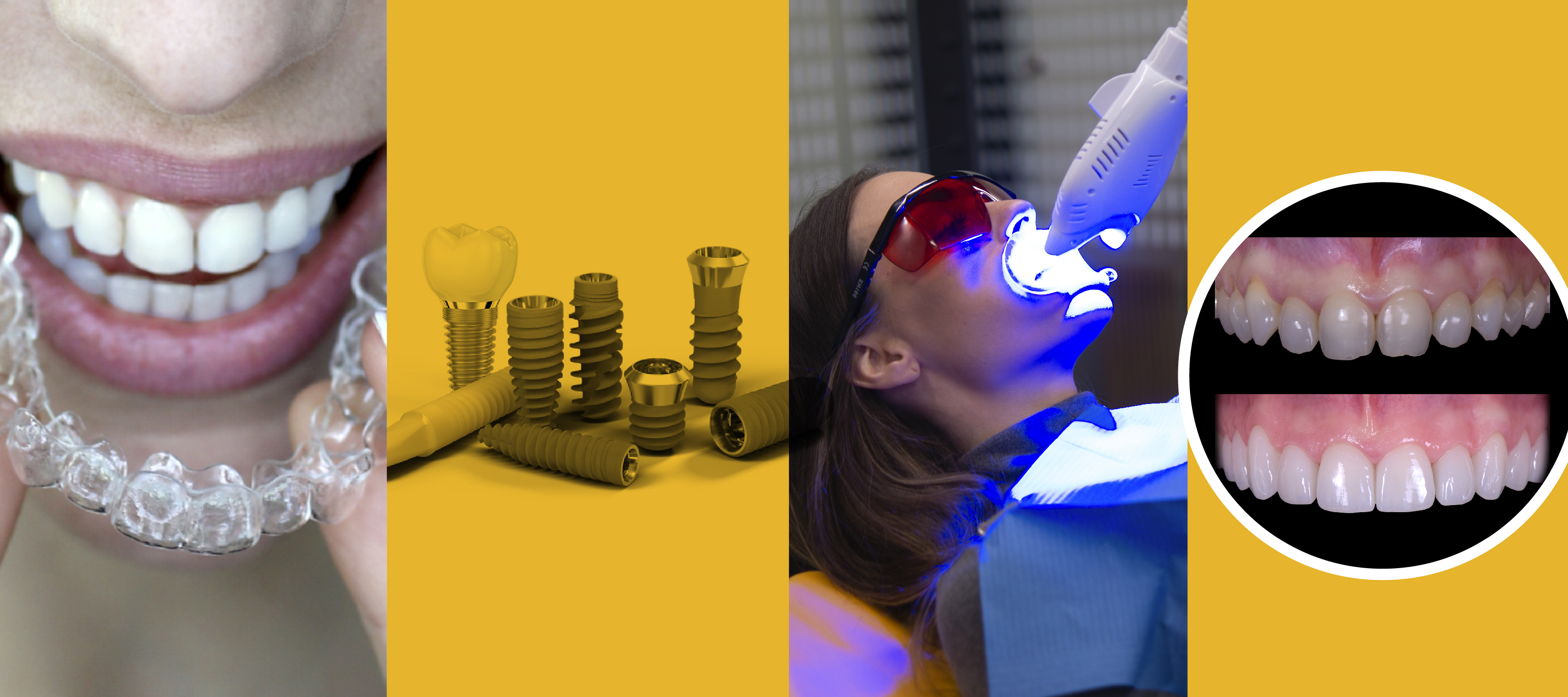 Cuatro tratamientos de odontología estética
