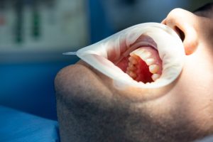 tiempo entre extracción e implante dental