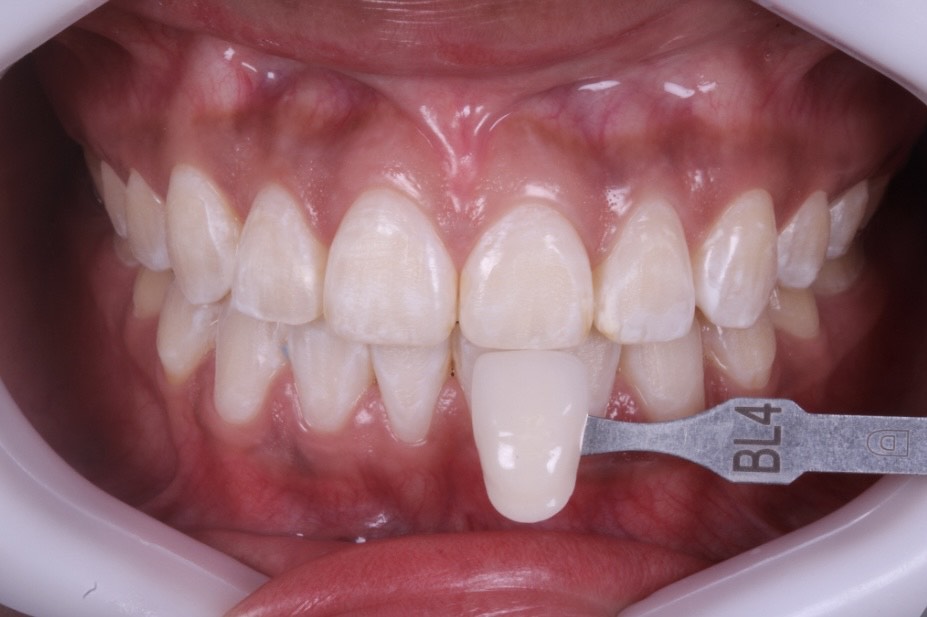 fundas dentales fijas