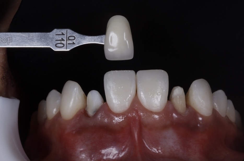 dientes separados