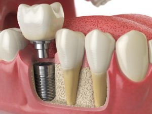 que comer después de un implante dental